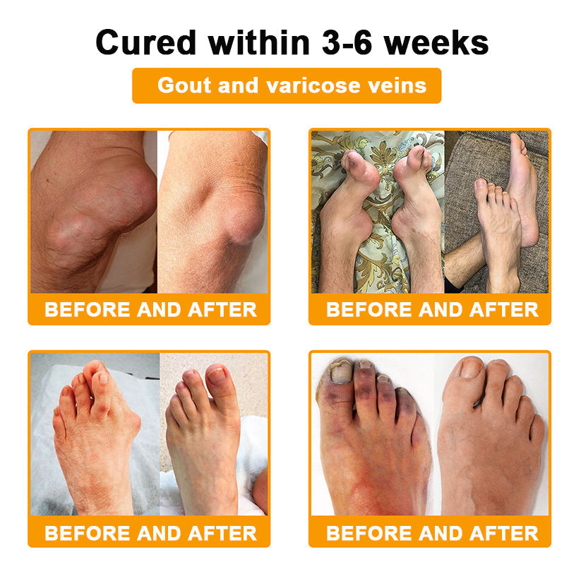 🎁Flash Sale - ODALIT™ Botulinum Toxin & Bee Venom Pain-Relief Bone Healing Cream🐝💎