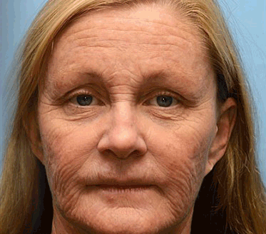 (Made and Shipped from USA) 🧑‍⚕️ODALIT™ Botox Bee Venom Wrinkle Removal Cream- LAST DAY 70% OFF🔥